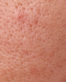 毛孔粗大的男性肌膚