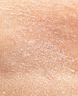 水分流失的男性肌膚