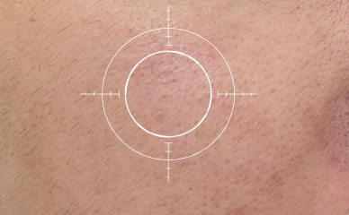 混合肌 使用前膚況